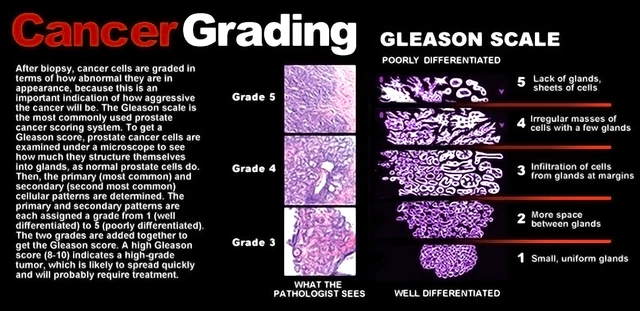 Prostate Adenocarcinoma Gleason