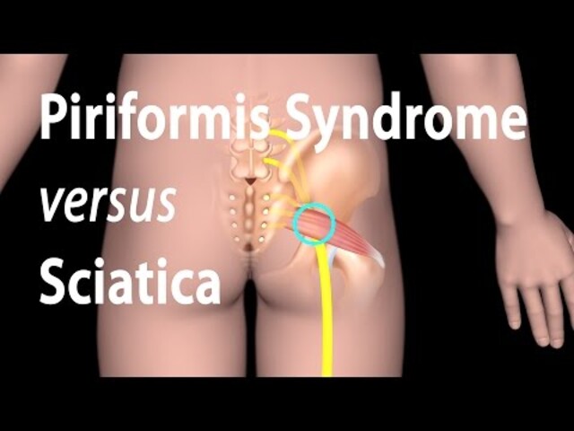 Sciatica - StoryMD