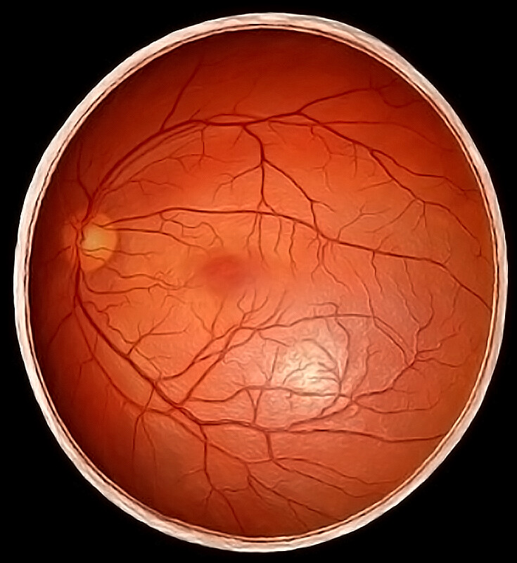 Types And Causes Of Retinal Detachment Storymd