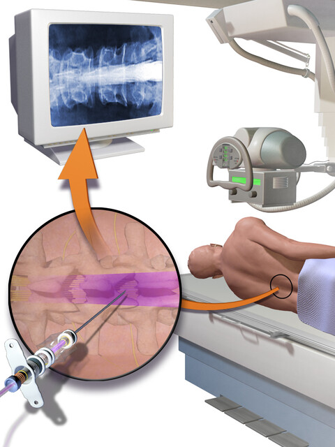 Myelogram Procedure