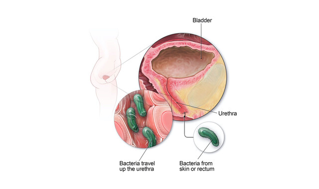 Severe Bladder Infection Symptoms Why Urinary Tract Infection(UTI) Is