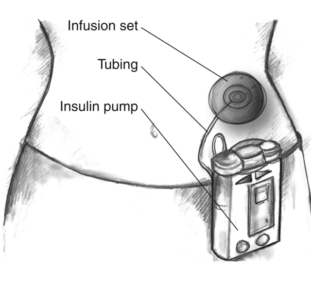 How to Use an Insulin Pump