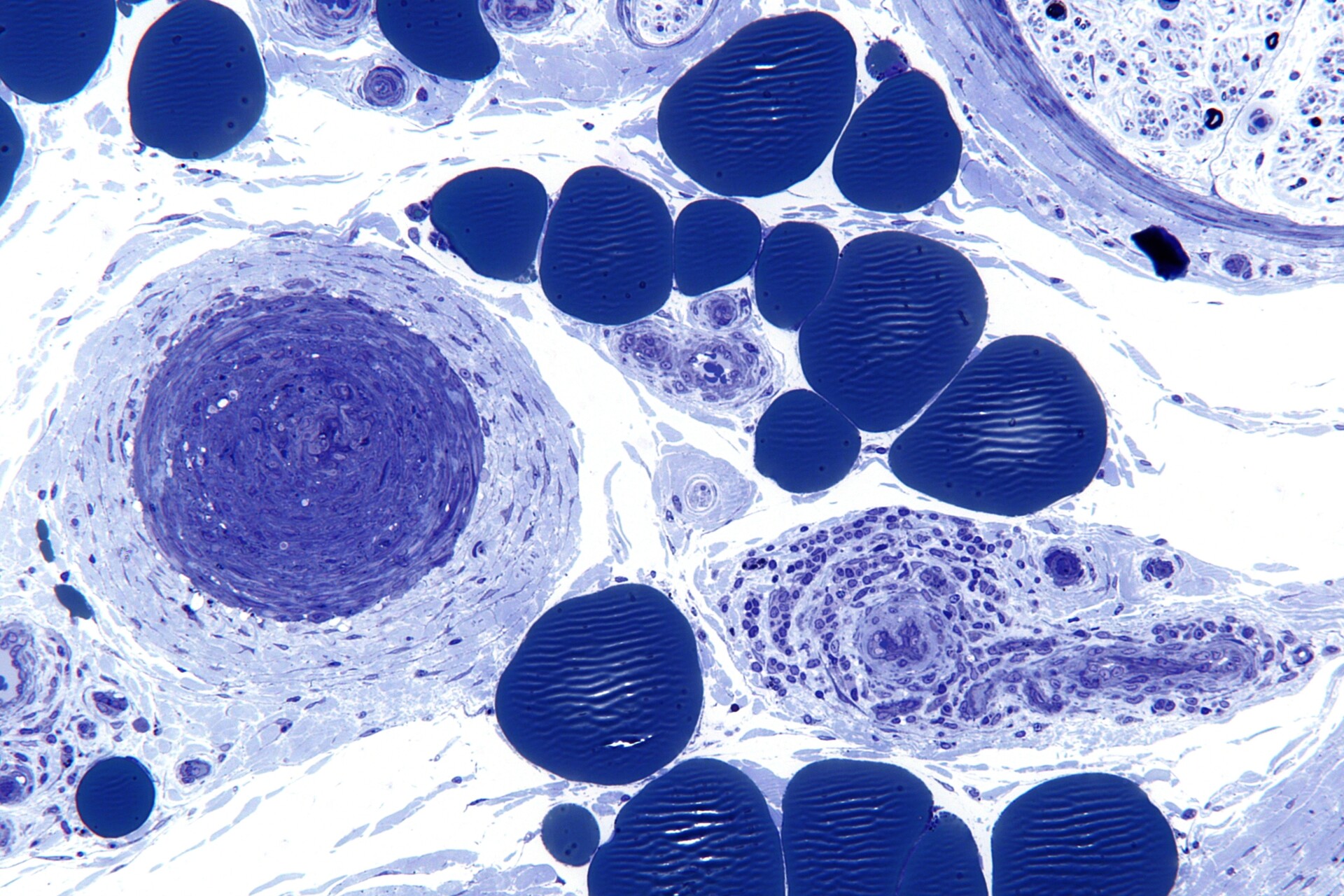 What Are The Signs And Symptoms Of Hereditary Spastic Paraplegia StoryMD what-are-the-signs-and-symptoms-of-hereditary-spastic-paraplegia-storymd