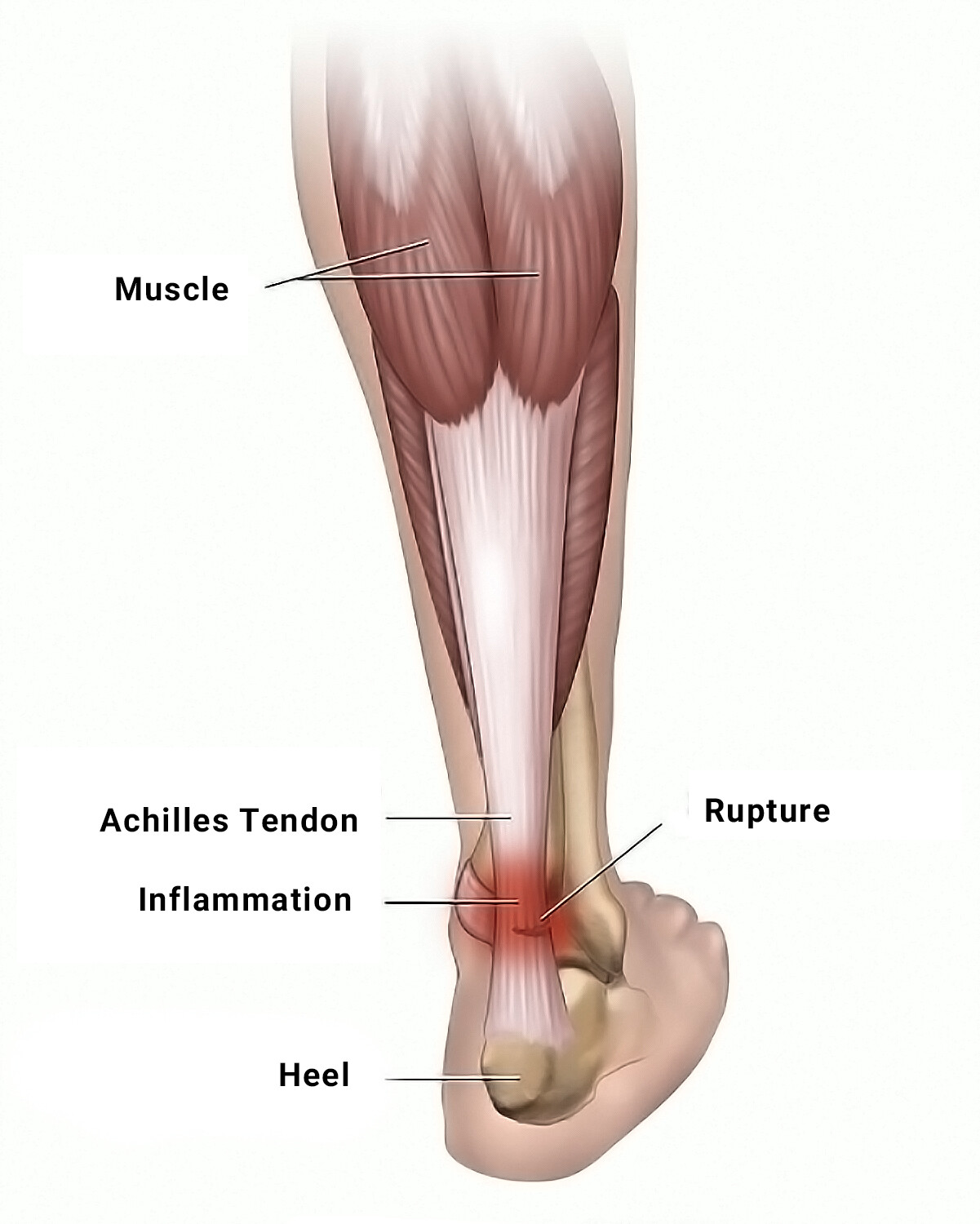 Calf Muscle Strain Injury - E3 Rehab