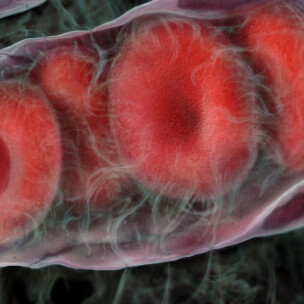 Red Cell Distribution Width (RDW); What Does This Lab Test REALLY Mean? 