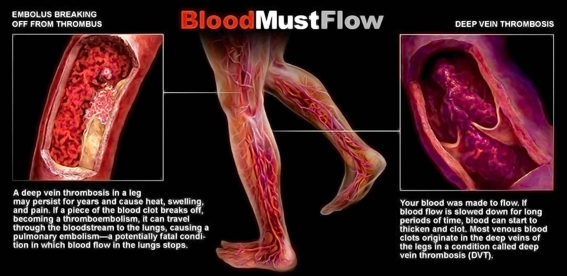Stop the Clot - A blood clot in one of the large veins, usually in a  person's leg or arm, is called a deep vein thrombosis or DVT. When a blood  clot
