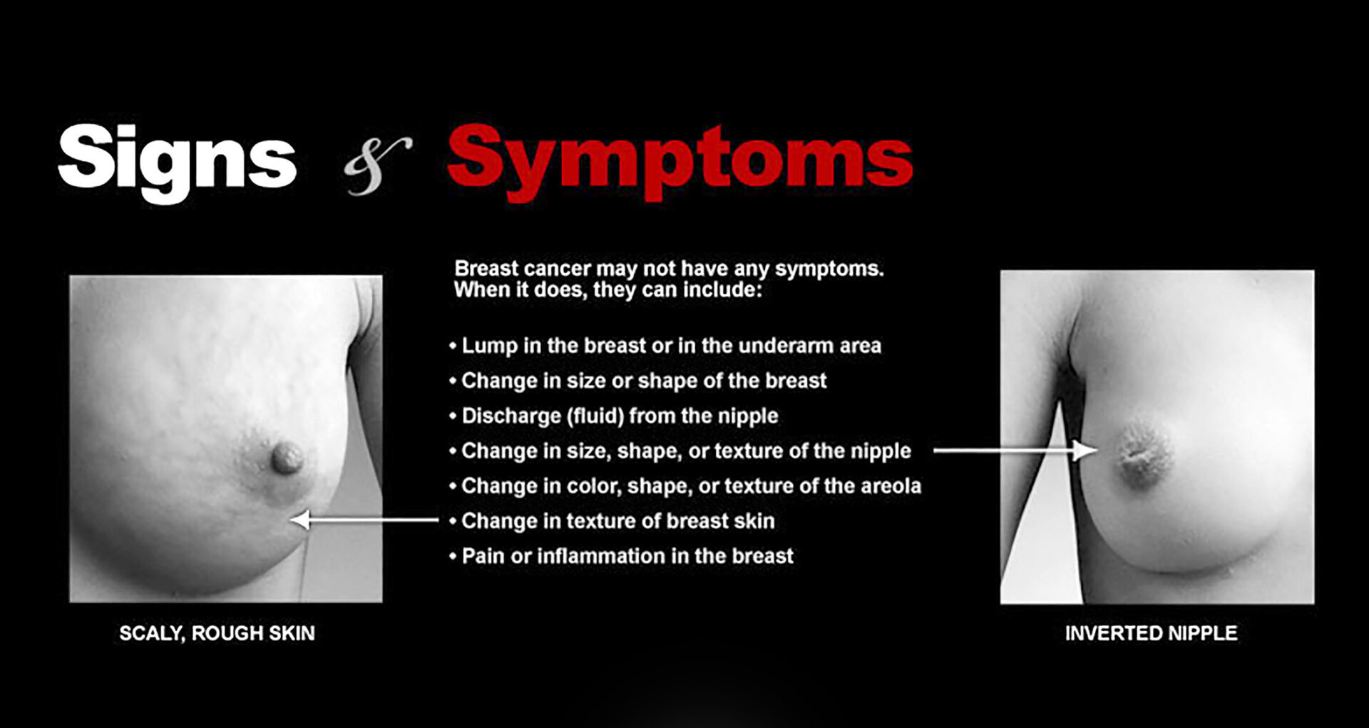 Breast Cancer Symptoms: Early Signs and When to See a Doctor