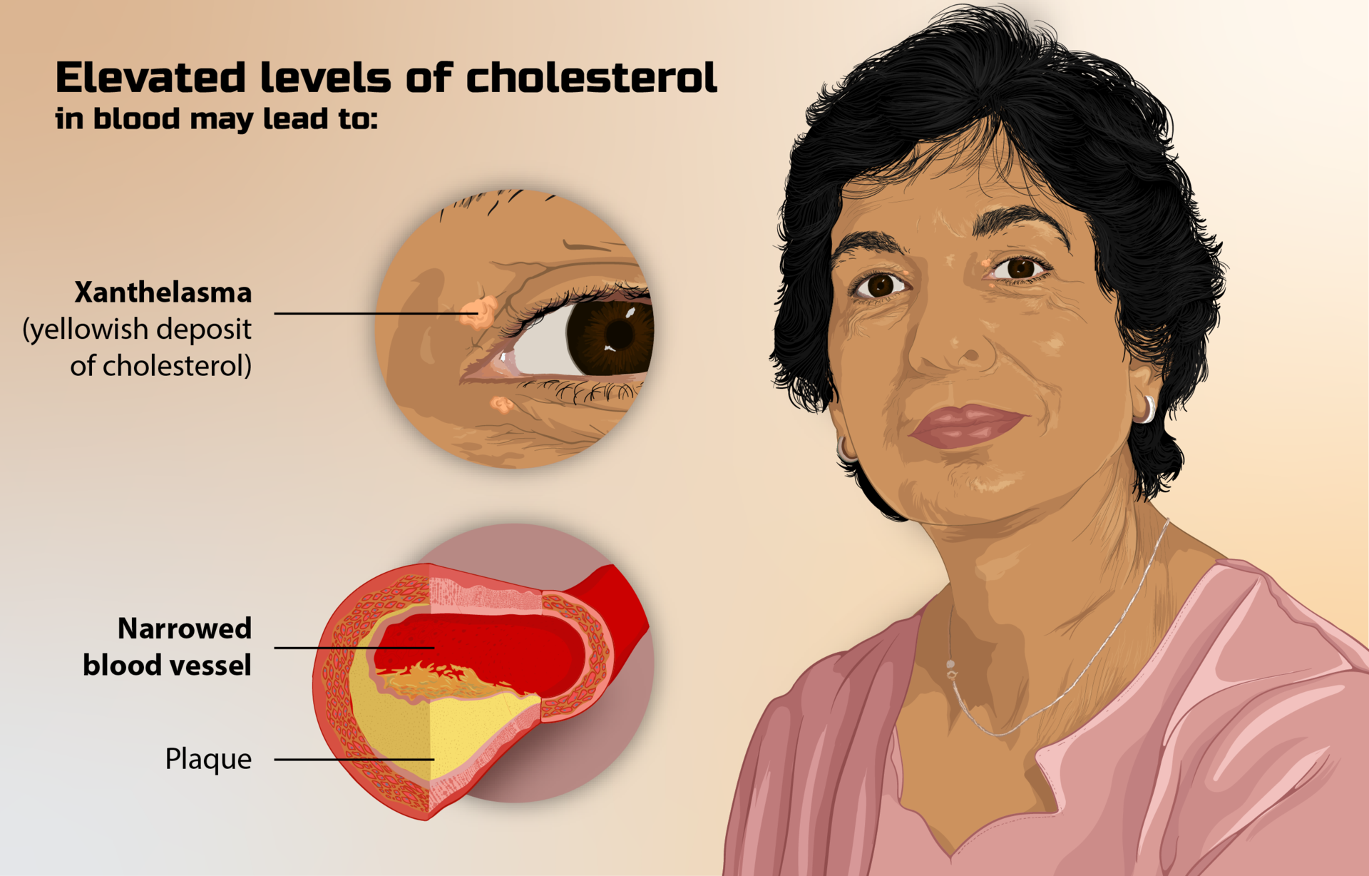 What Are the Signs and Symptoms of Familial Hypercholesterolemia? StoryMD