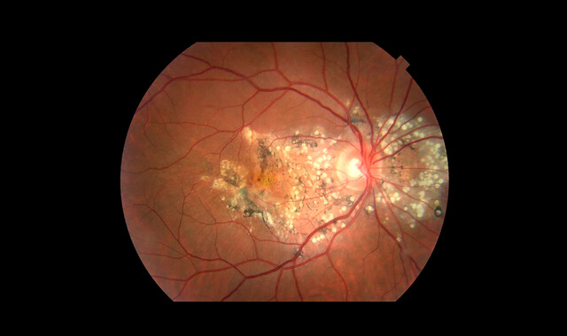 Doyne Honeycomb Retinal Dystrophy (DHRD): Treatment, Prognosis - StoryMD