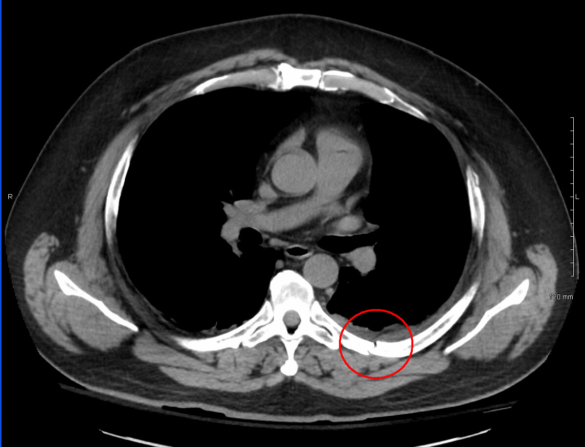 Rib Fractures Diagnosis and Prognosis StoryMD