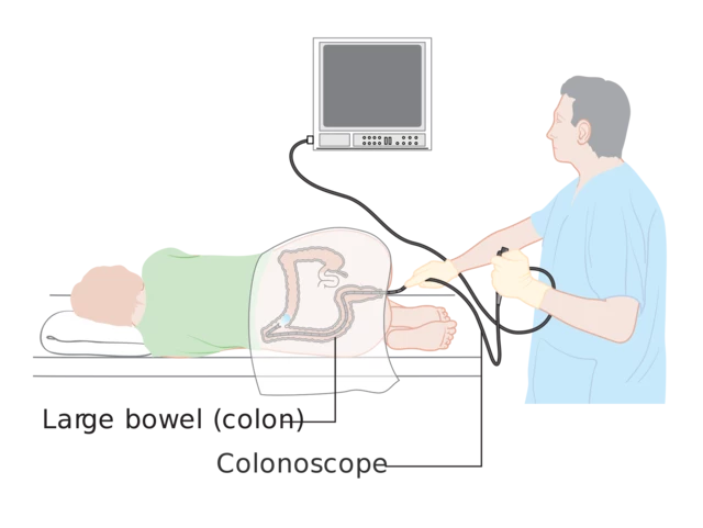 colonoscopy scope