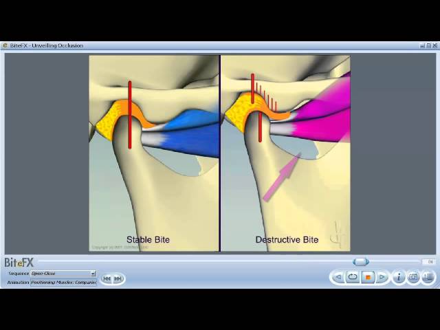 Temporomandibular Joint Dysfunction - StoryMD