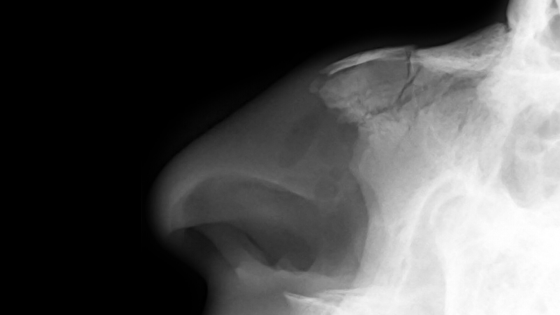 nasal bone x ray anatomy