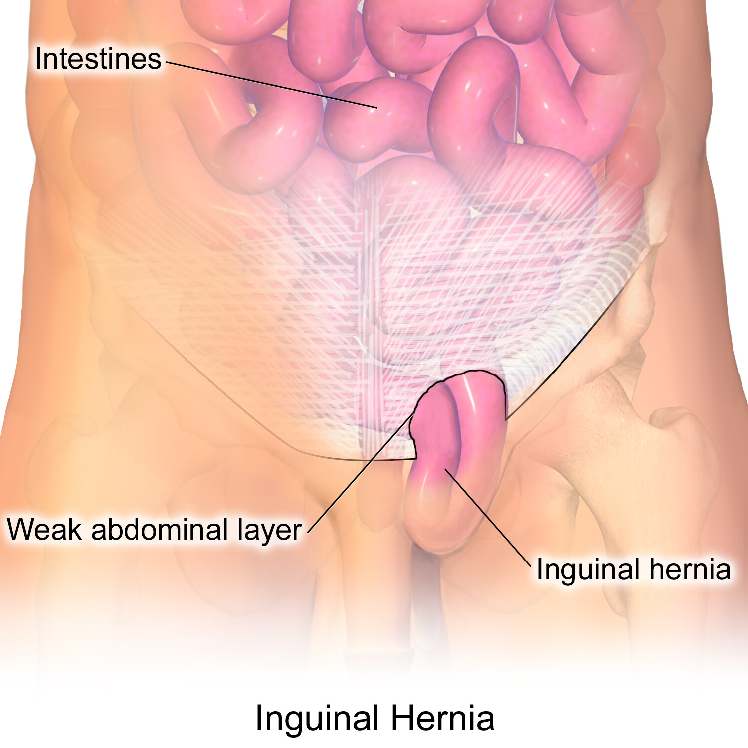 What Is an Inguinal Hernia? - StoryMD