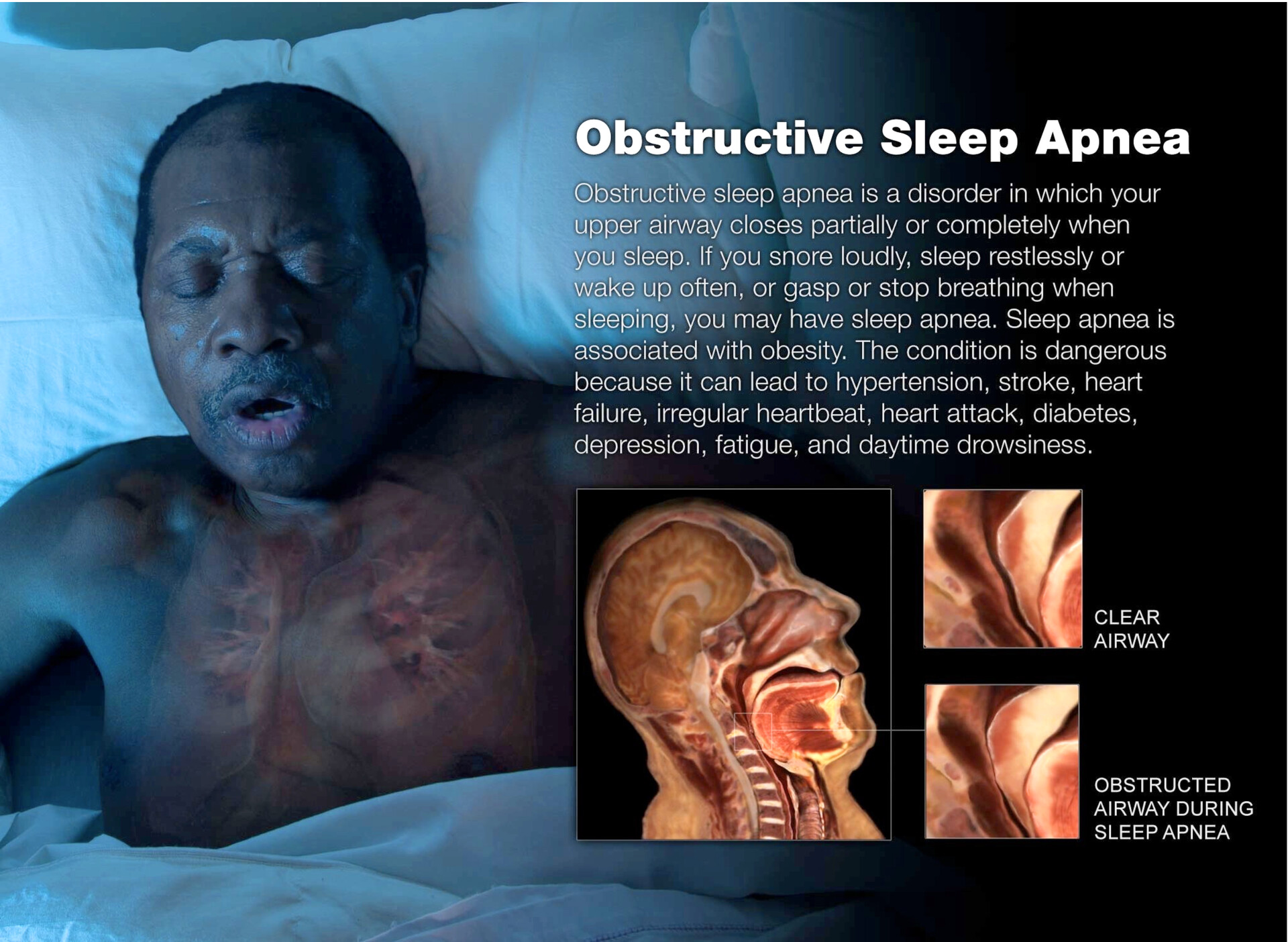 What Causes Sleep Apnea? - StoryMD