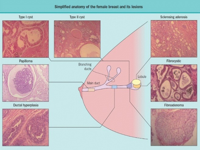 what-are-the-symptoms-of-breast-cysts-storymd