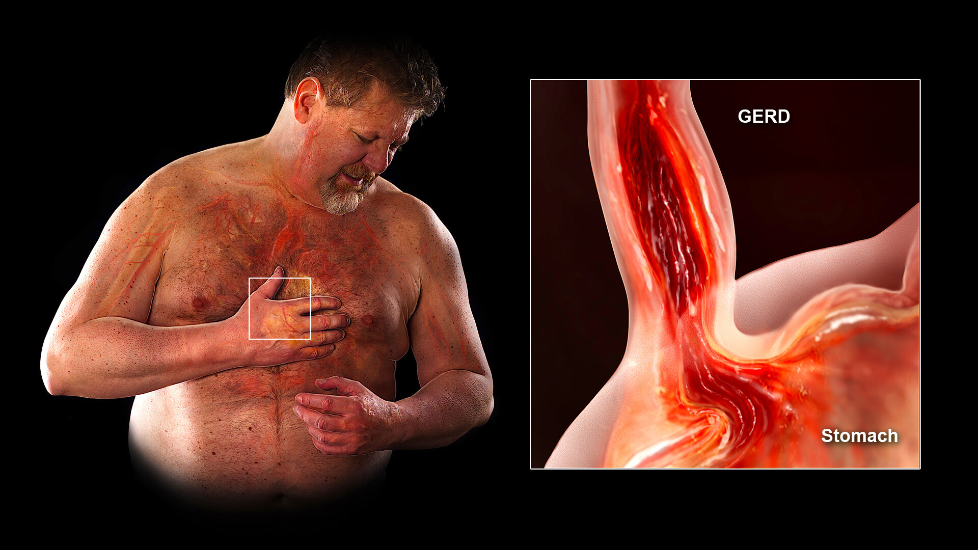 gerd with glp 1 Risk of and Barrett's Esophagus New Study finds that Patients Type 2 Diabetes who take GLP-1 receptor agonist (RA) like Ozempic and Wegovy experience much more Gastroesophageal Reflux Disease (GERD) gerd and glp-1 Potential Use