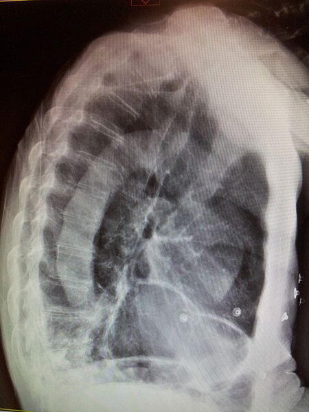 Thoracentesis - StoryMD