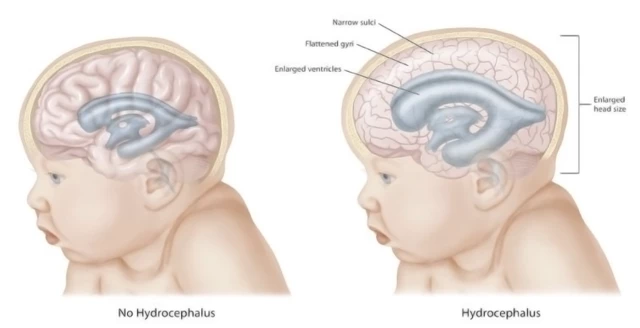 Megalencephaly Causes