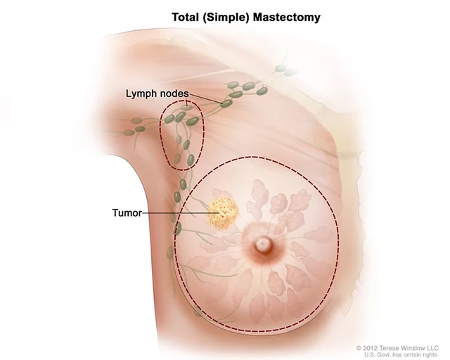 Mastectomy/Lumpectomy - StoryMD