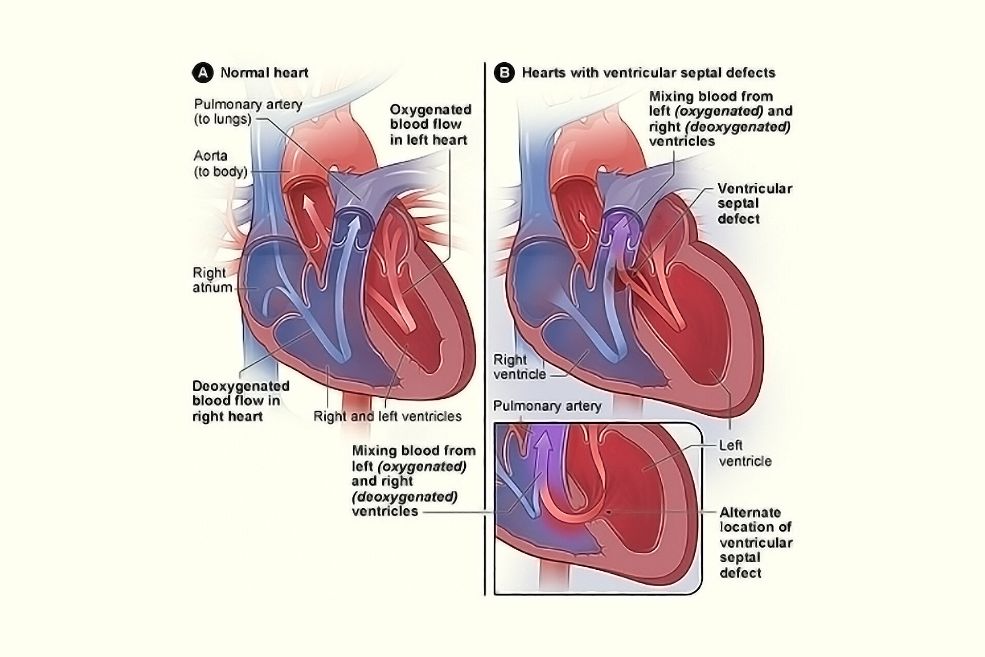 Vsd Types Radiology Ventricular Septal Defect Definition Causes Symptoms Vrogueco