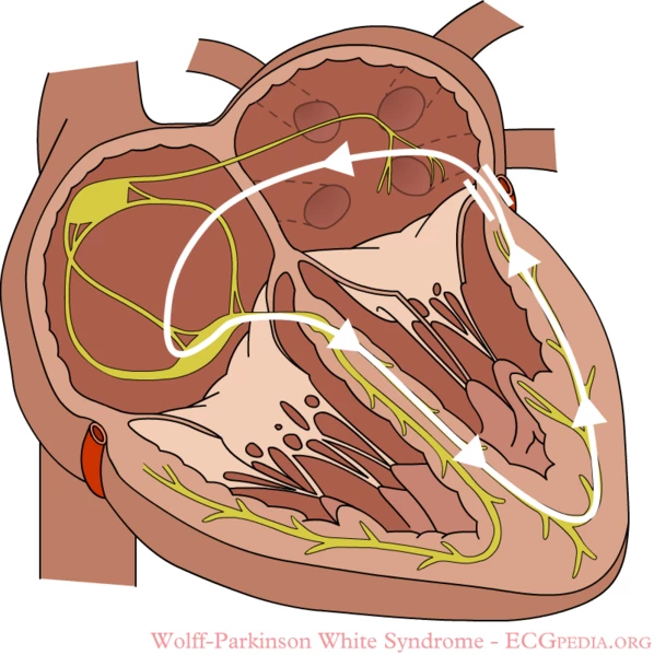 wolf parkinson syndrome ablation