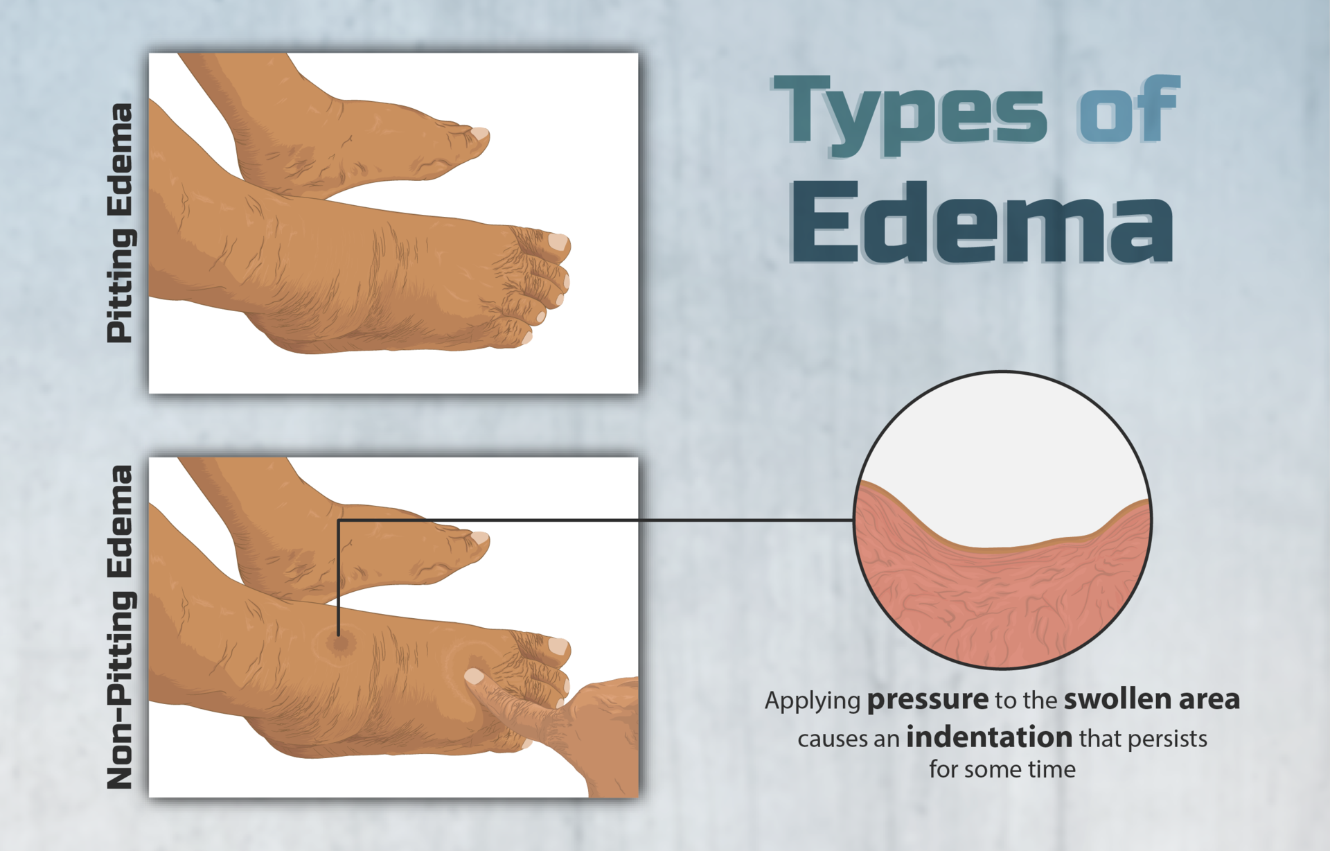 sacral area edema