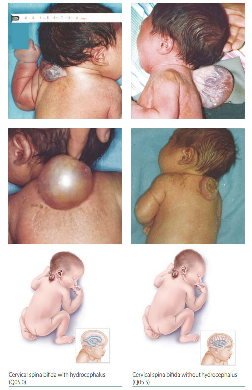 【後払い手数料無料】 Causes, Bifida: Spina Treatment, StoryMD - Prevention 洋書
