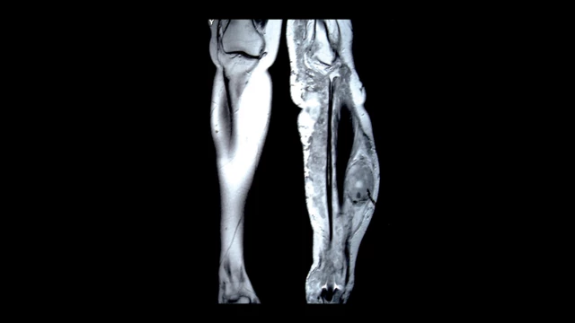 Legius Syndrome