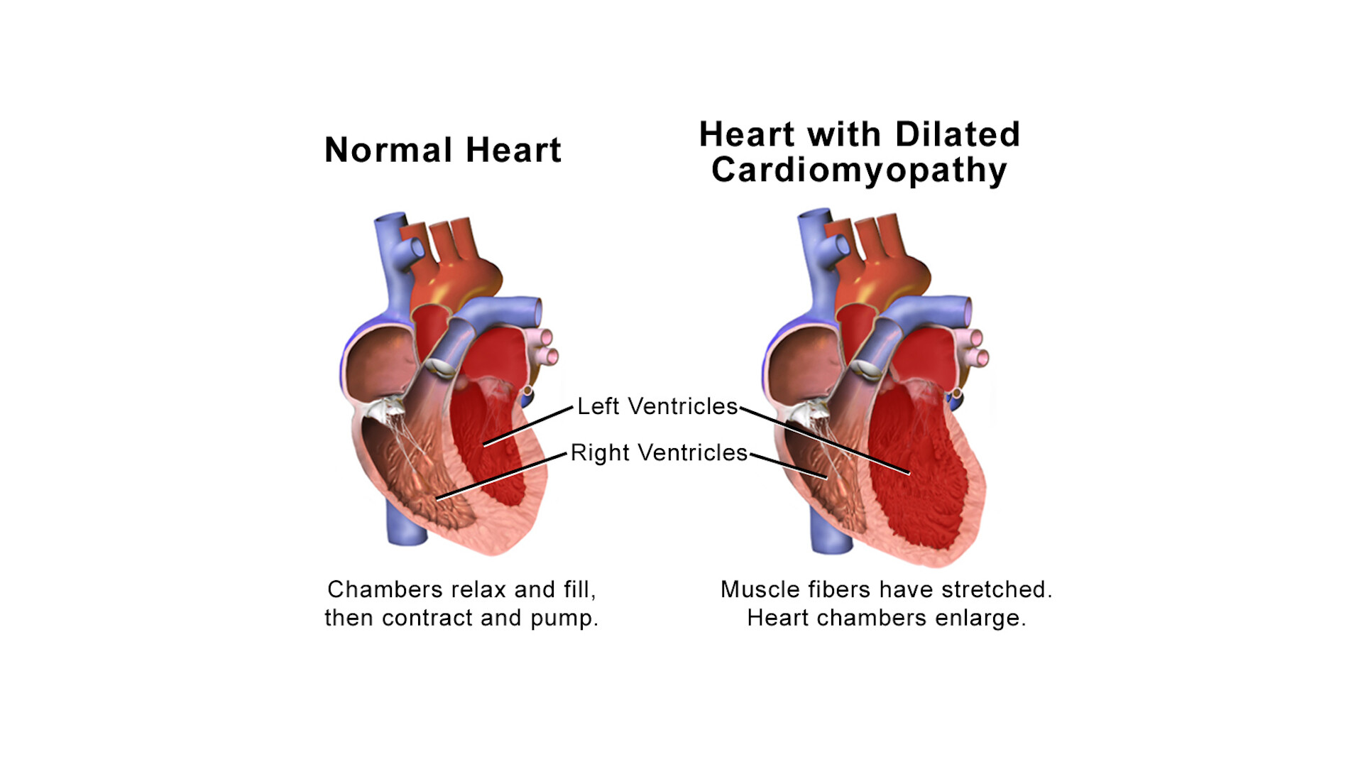 What Are the Signs and Symptoms of Danon Disease? - StoryMD