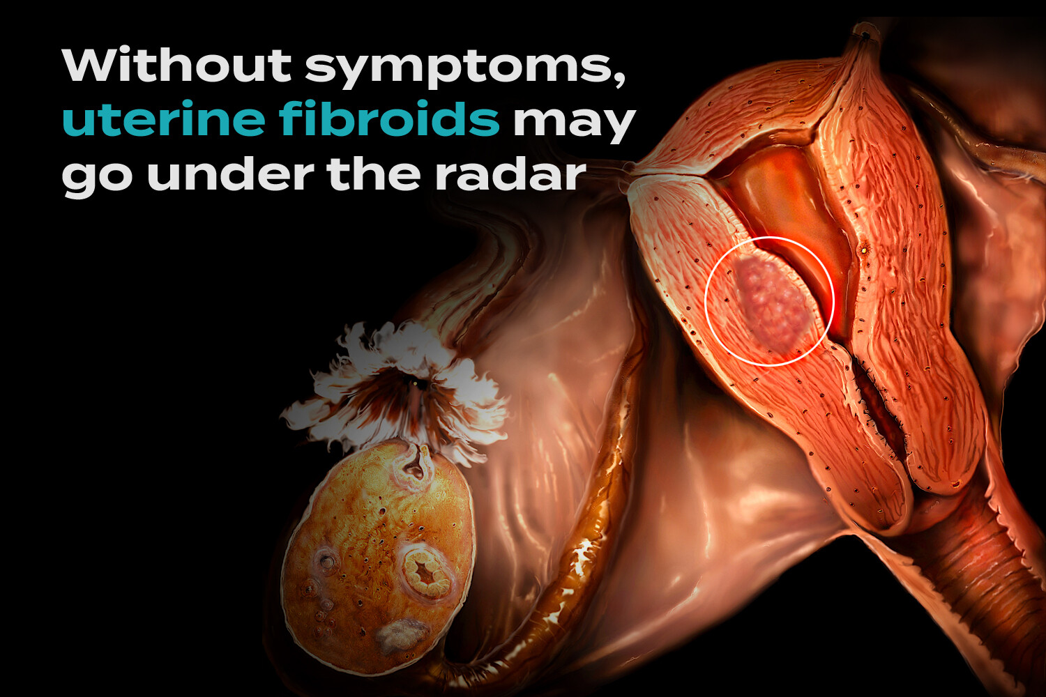 glp 1 fibroids Uterine Fibroids Don't Always Like to Make Their Presence Known