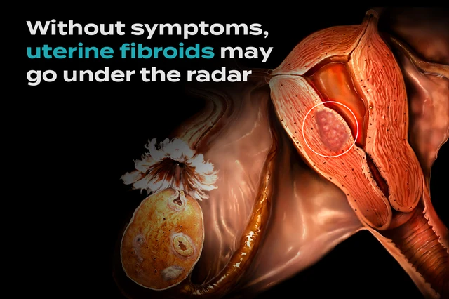 Uterine Fibroids Don't Always Like to Make Their Presence Known