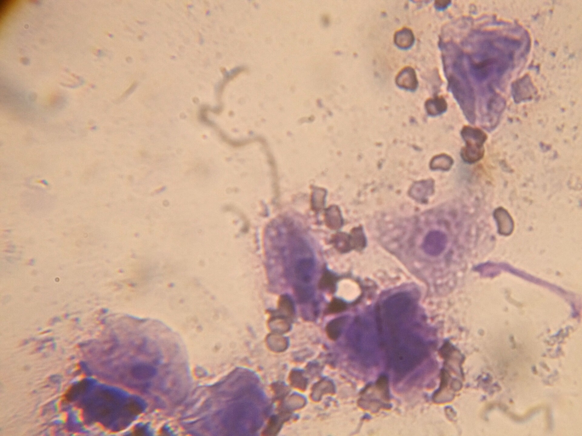 What Is Ovarian Remnant Syndrome? StoryMD