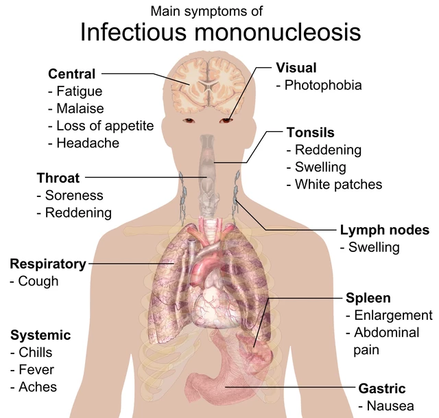 Mononucleosis Causes, Symptoms, and Treatment