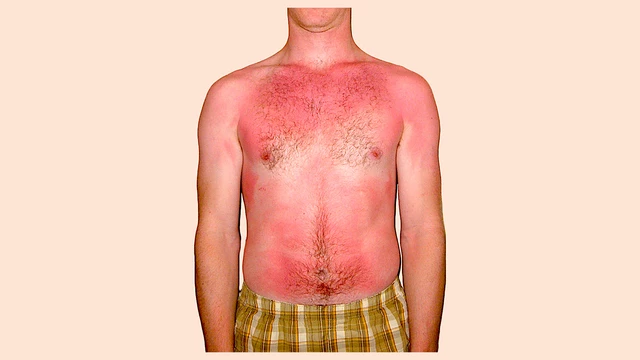 Moderate Sunburn How To Treat Severe Sunburn | Complete Care