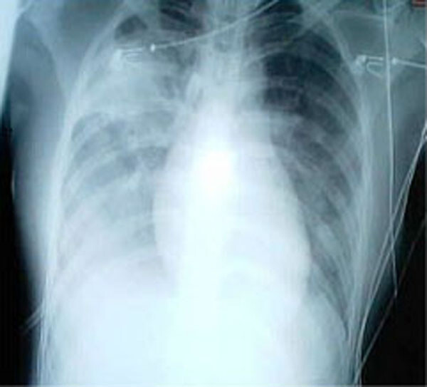 Thoracentesis - StoryMD