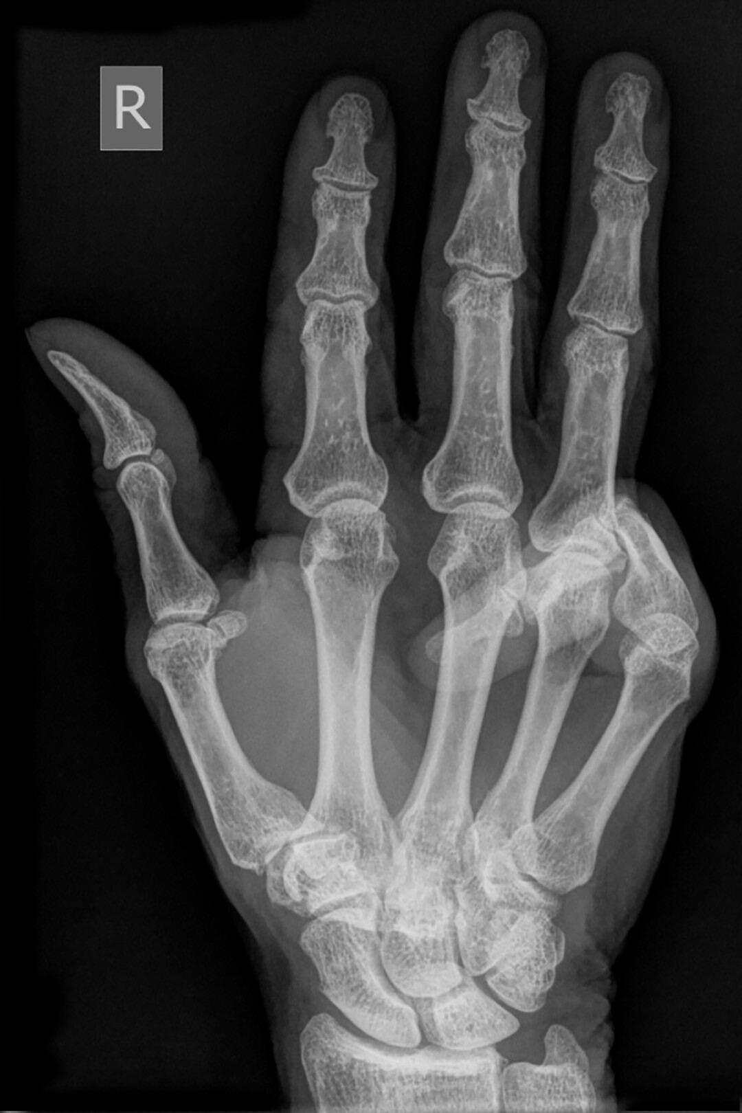 What Is Dupuytren Contracture? StoryMD