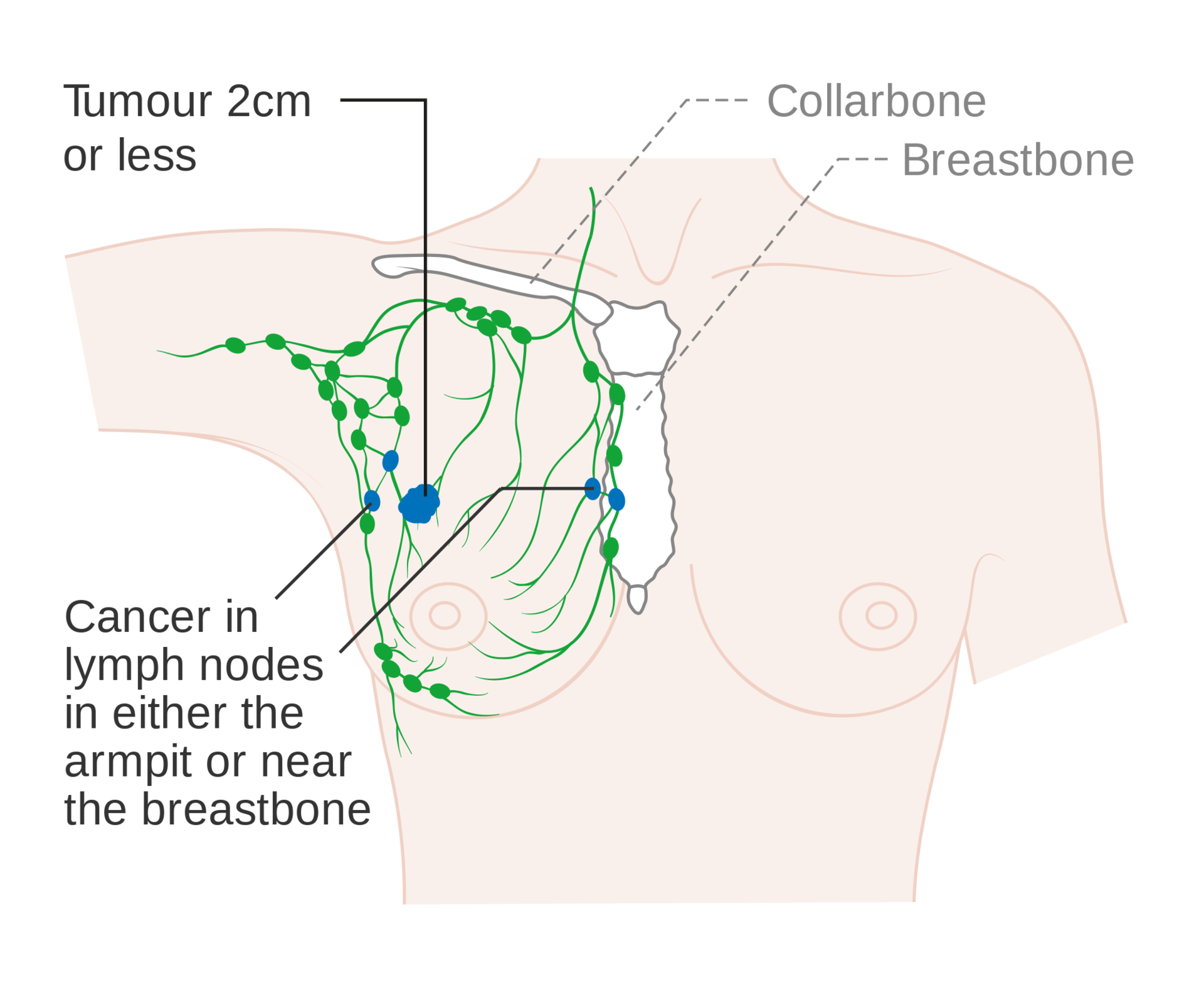 Breast Cancer Staging Examples - StoryMD