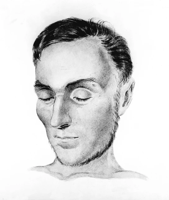 Addison Disease Face Face Of A Man Suffering From Addison's Disease.