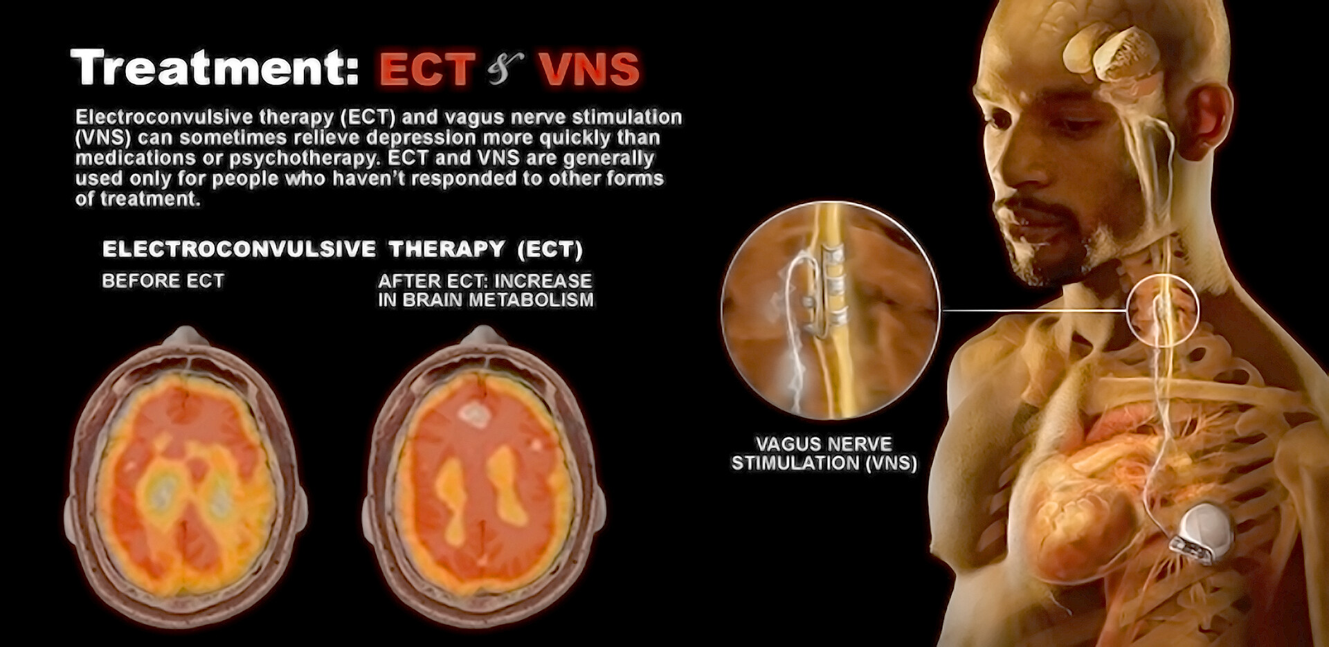 Vagus Nerve Stimulator (VNS) Implants
