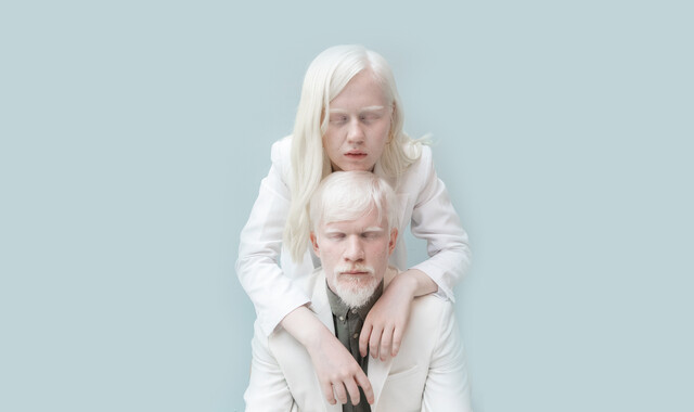 Albinism: Inheritance, Treatment, Prognosis - Maiden Lane Medical