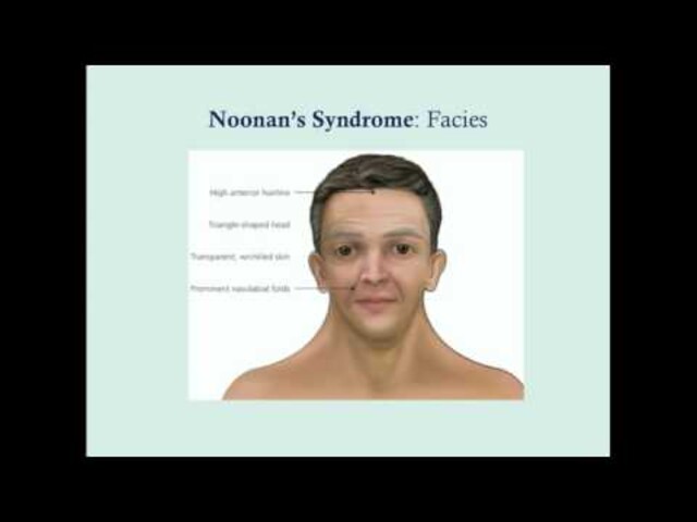 What Is Rubinstein-Taybi Syndrome? - StoryMD