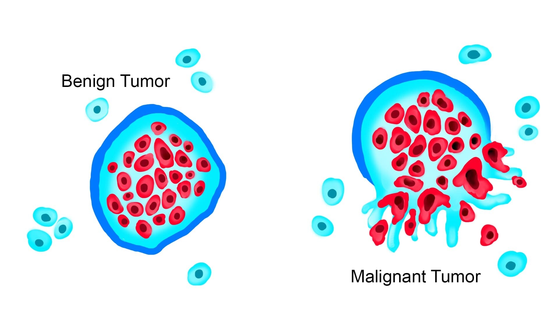 benign tumor vs malignant