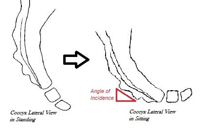 Tailbone Pain Explained: Causes, Symptoms & Treatment