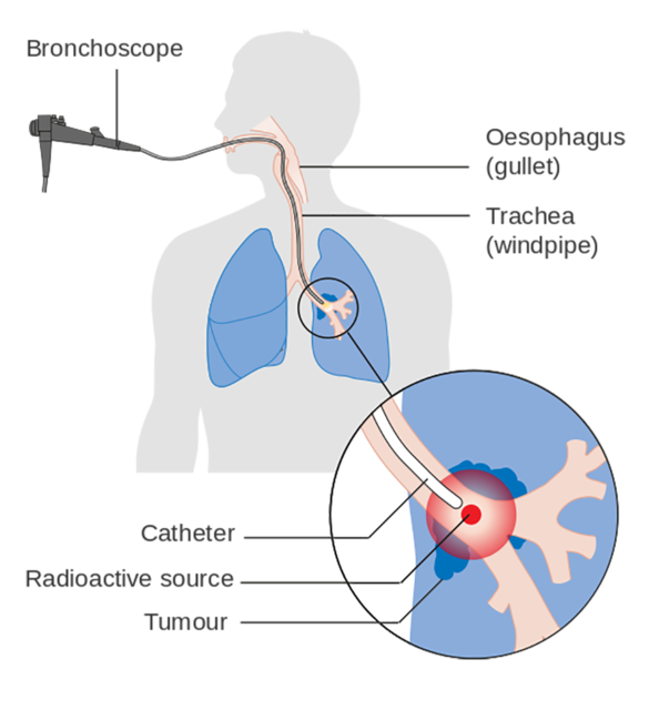 Thoracentesis - StoryMD