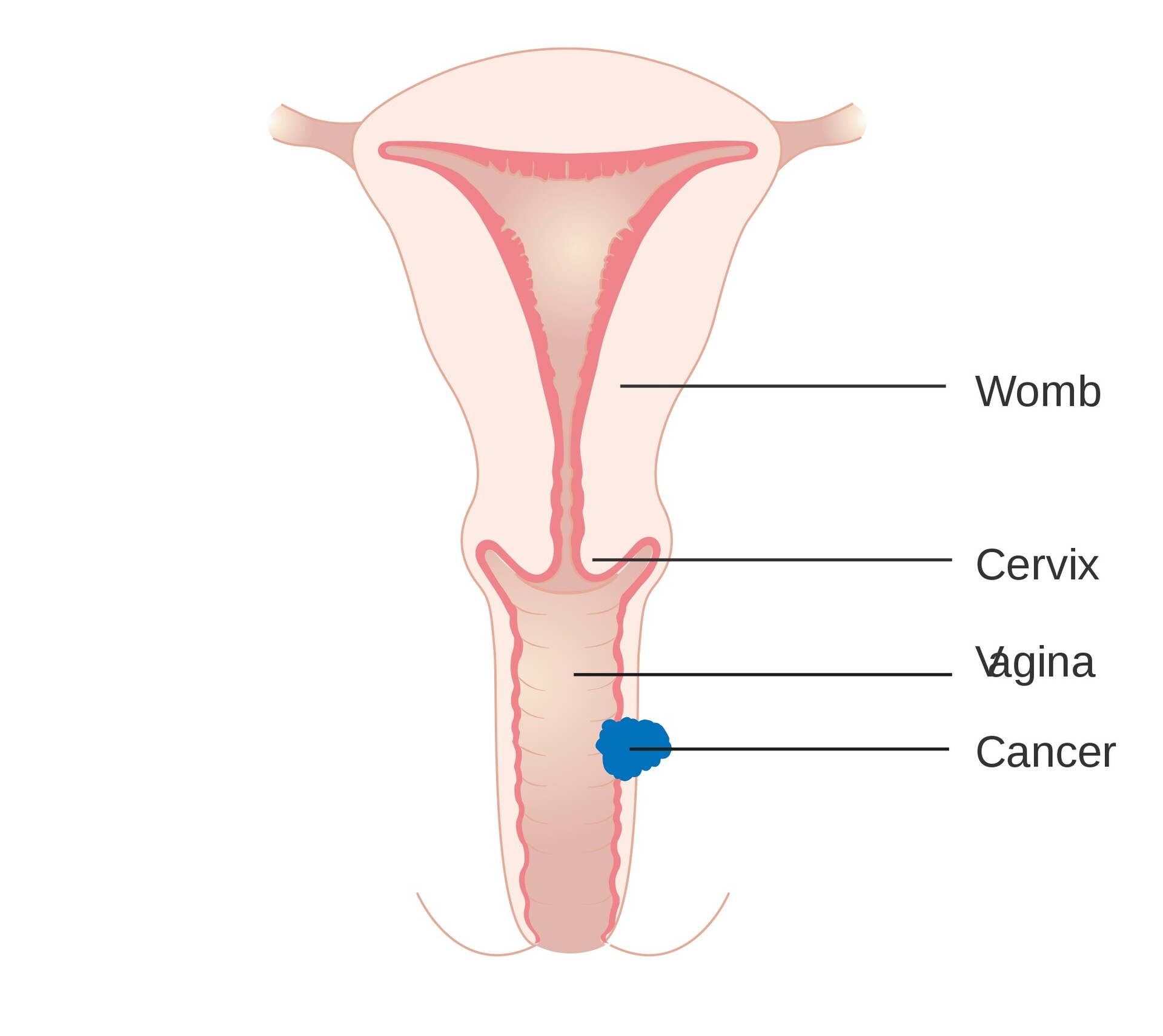 How Are Gynecologic Cancers Treated?