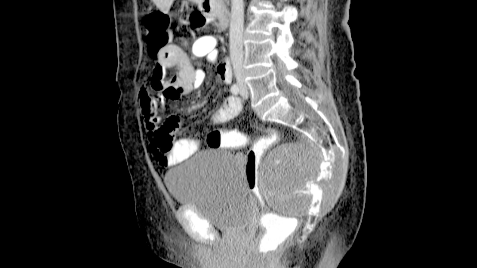 Chordoma - StoryMD