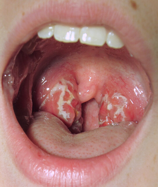 Candida Yeast Infections of the Mouth Throat and Esophagus StoryMD