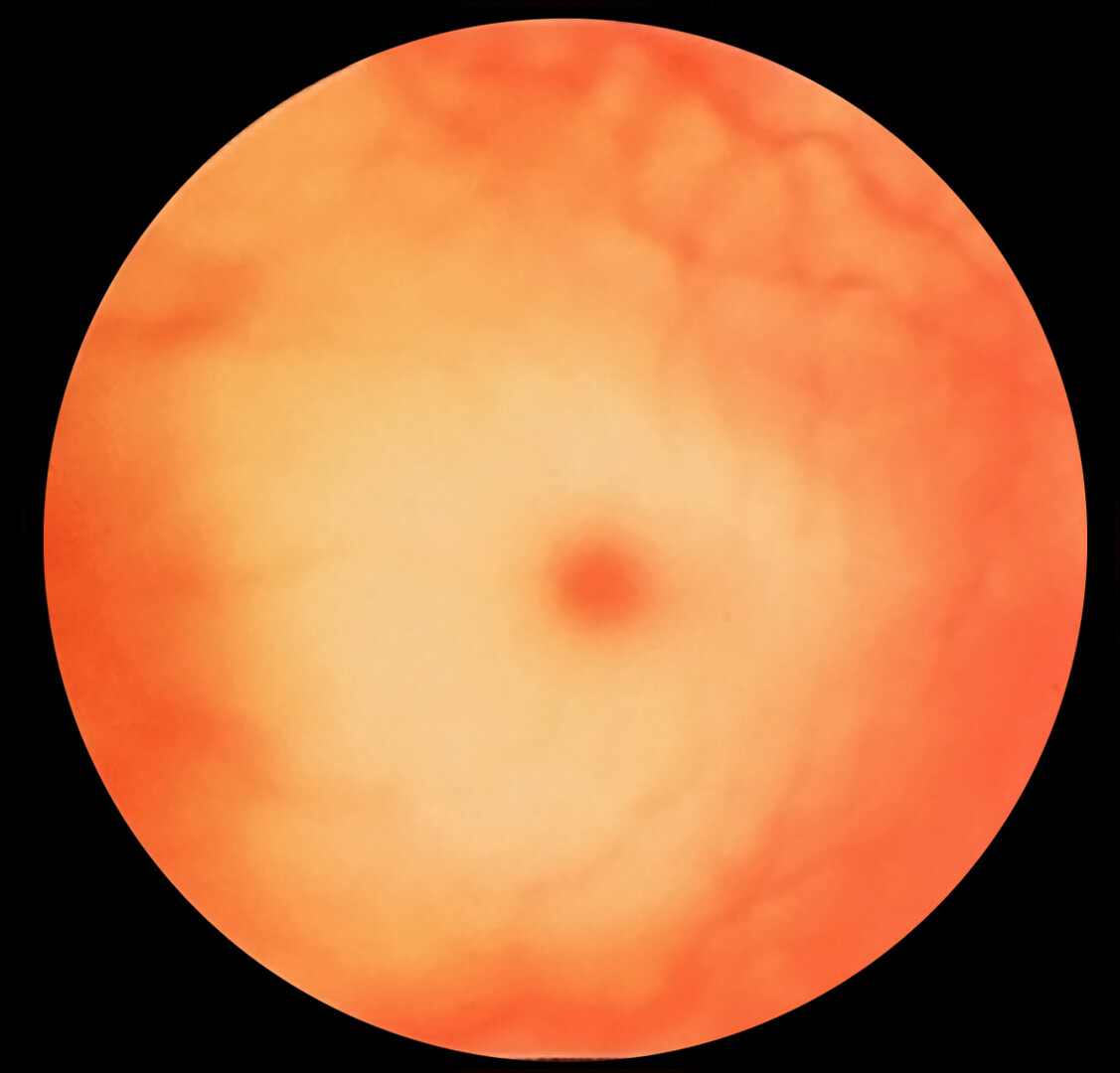 Cherry-Red Spot in Tay–Sachs Disease