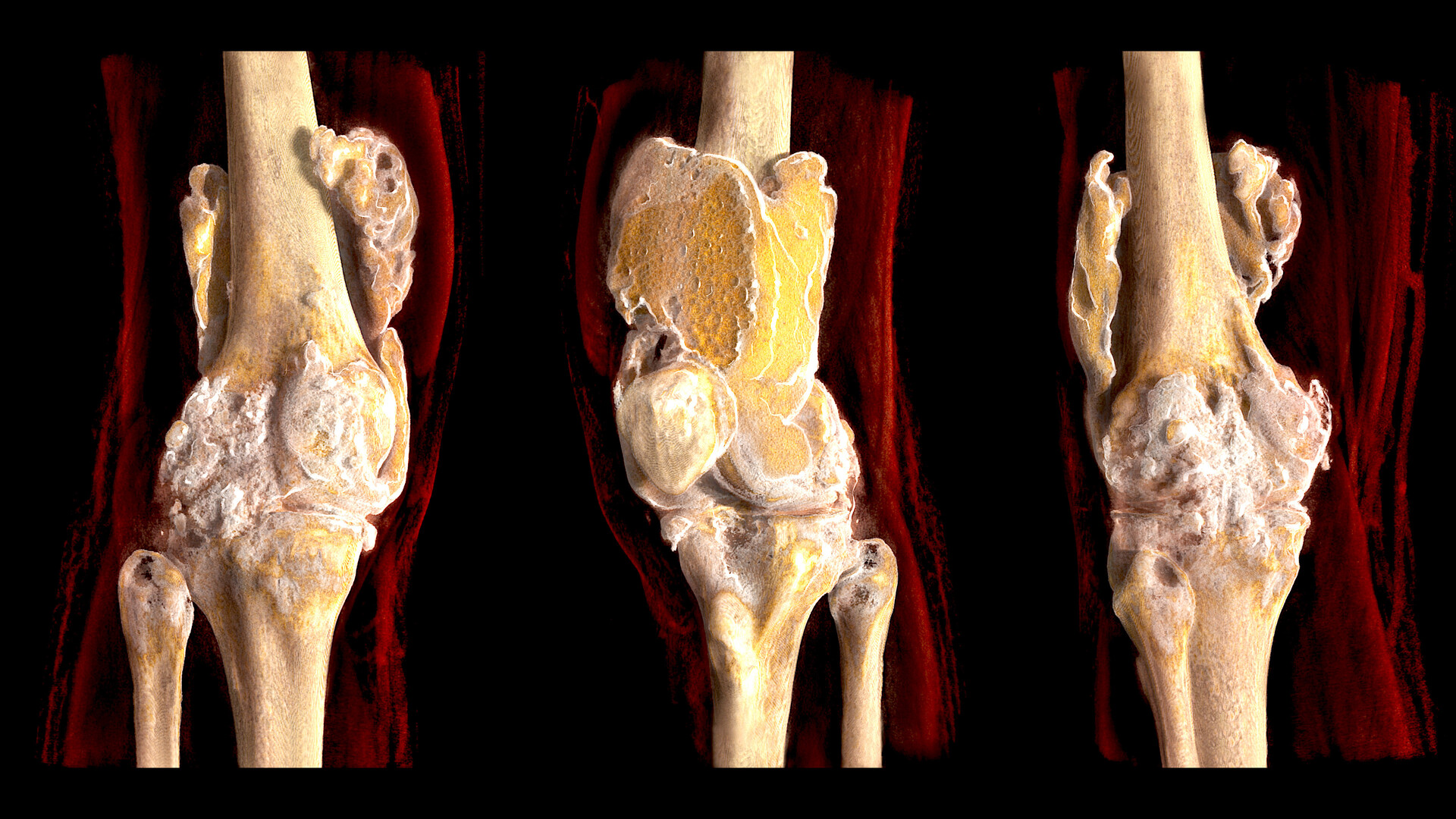 Arthritis Panel Why Is It Done and What the Results Mean StoryMD